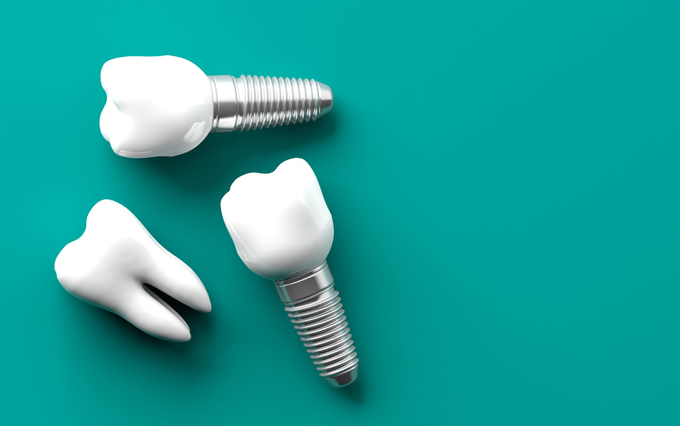 implantes dentários: tipos, como escolher