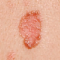 cancro da pele sintomas: Carcinoma basocelular