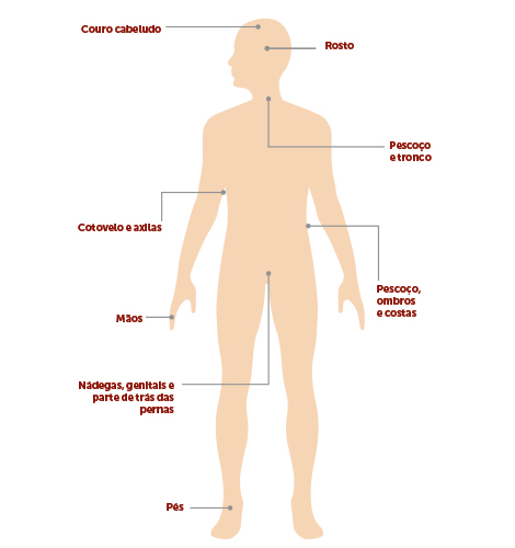 autoexame-da-pele: cancro da pele sintomas