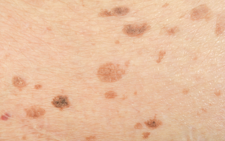 Cancro da pele: sintomas e sinais