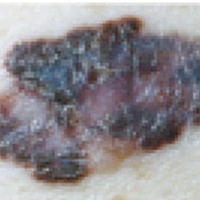 cancro da pele sintomas: cinal com bordo irregular